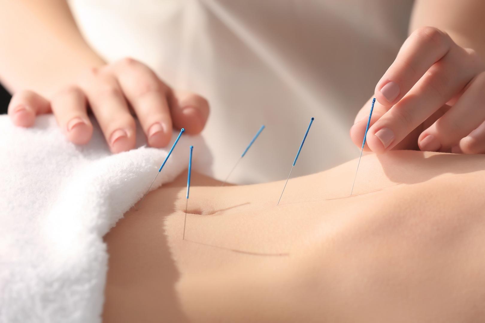 Chinese acupuncture Chinese herbal medicine Templestowe Lower Melbourne